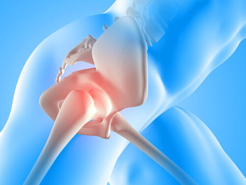 Incidencia de fractura de cadera en Costa Rica: Consulte a especialistas en Ortopedia