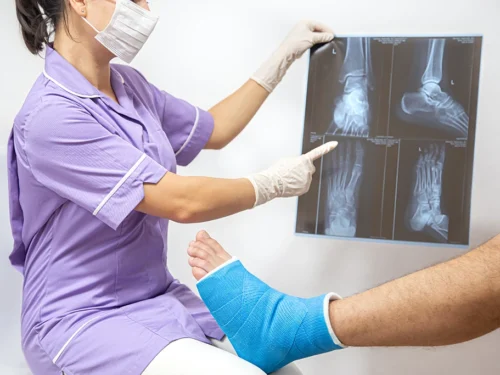 ¿Cómo se trata una fractura bimaleolar?