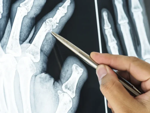 Radiografías ortopédicas: ¿qué pueden detectar y cuándo solicitarlas?